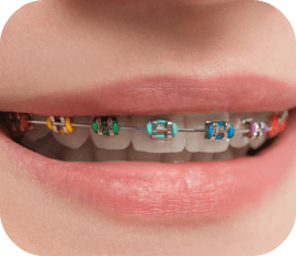 color braces in mooresville