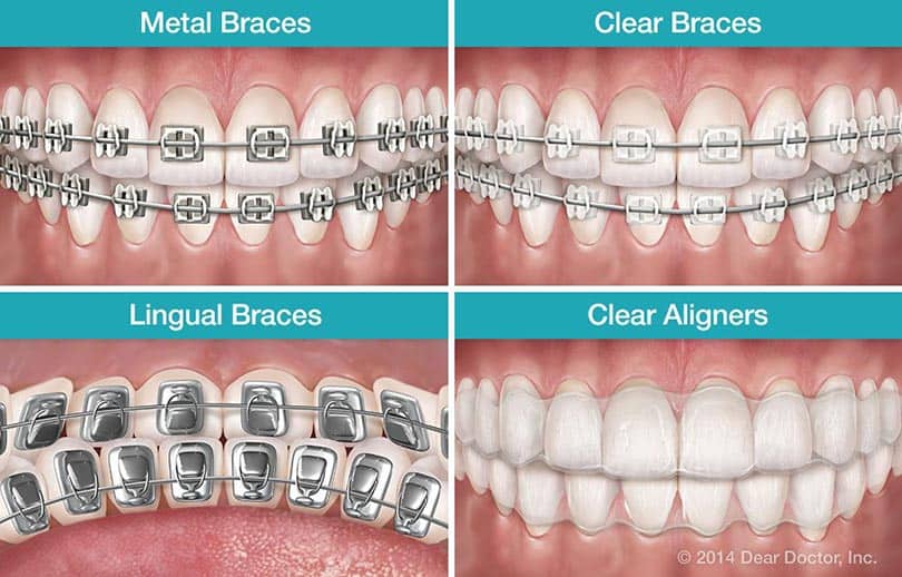 The Different Types of Braces: Which One Is Right for You?